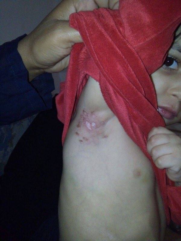 بالصور.. رجل يعذب ابنة زوجته ويكويها بالنار فى أماكن حساسة