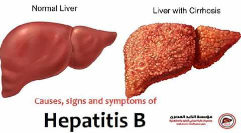معلومه صحيه :الأعراض اﻹصابة بفيروس الالتهاب الكبدى بى