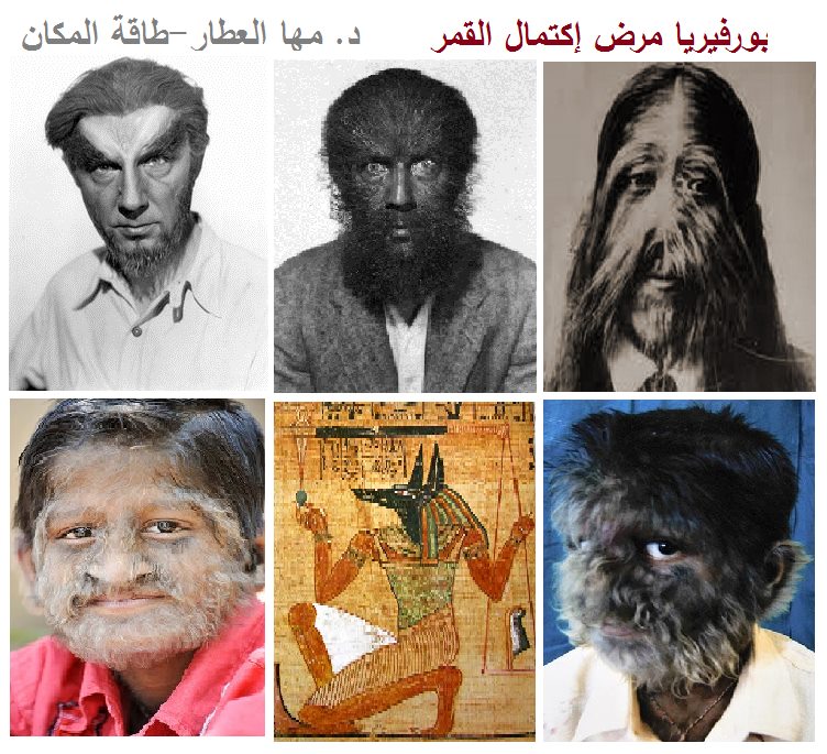الجلوس فى ضوء القمر يسبب البورفيريا
