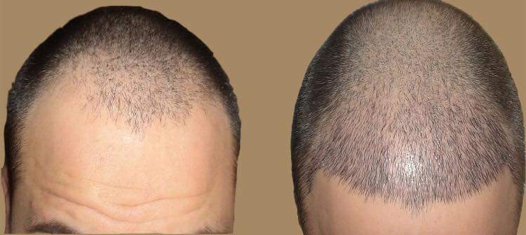 زراعة الشعر وتأثيرها الفعال للرجال